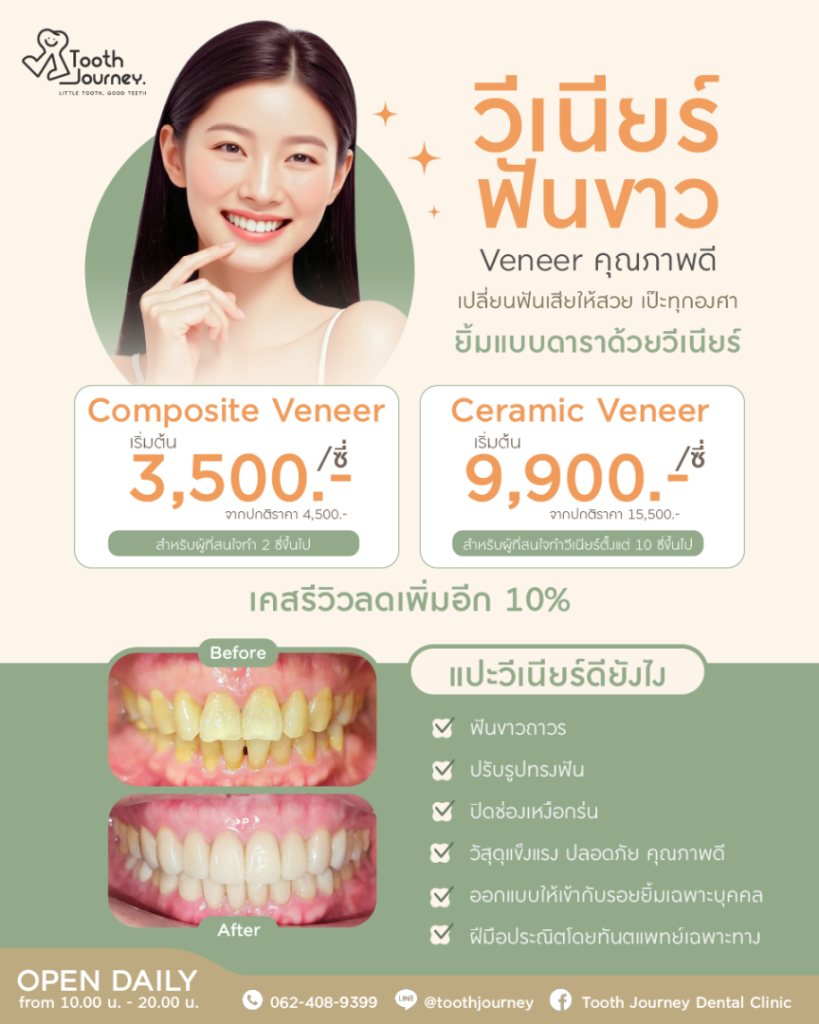 วีเนียร์