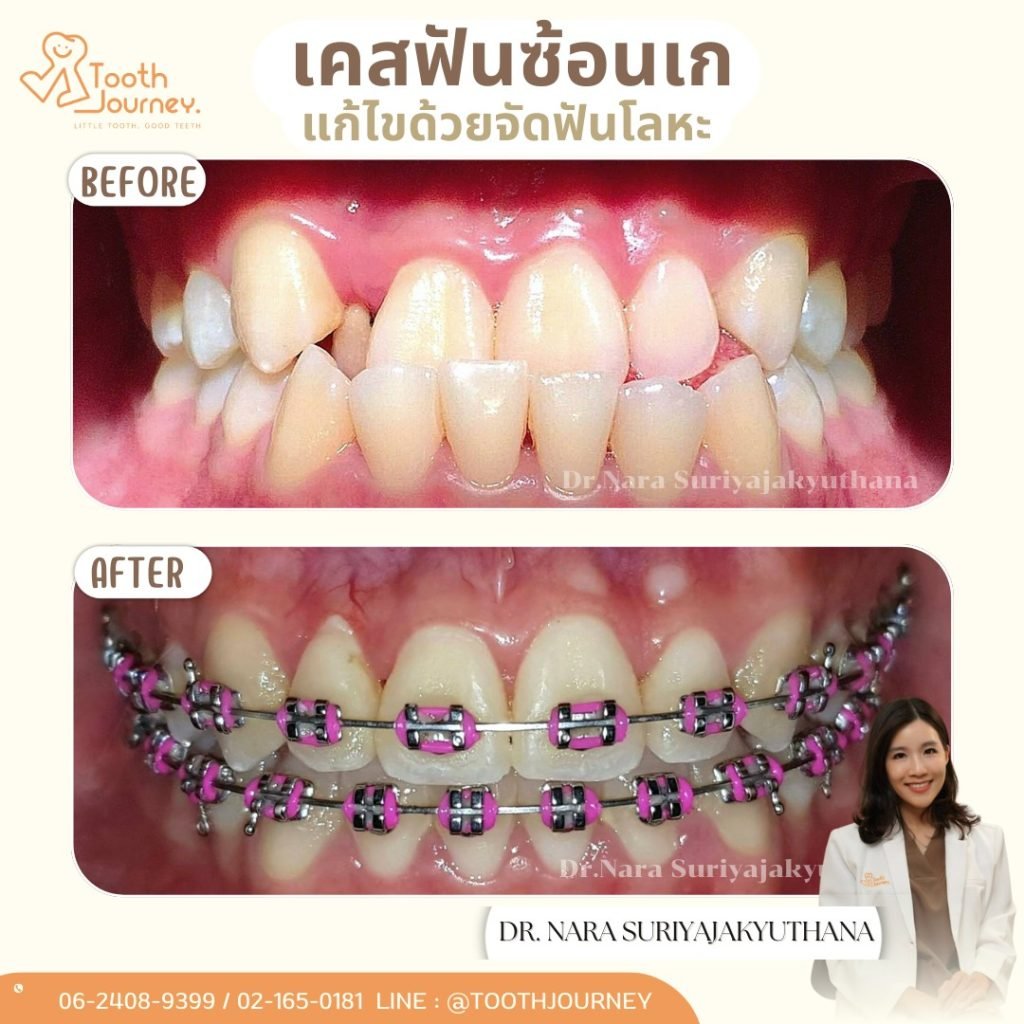 LINE_ALBUM_ตัวอย่างเคส B_A_250901_1