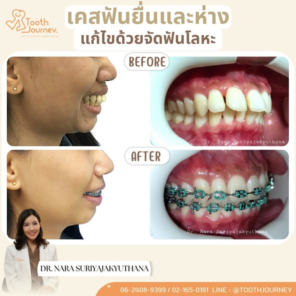 LINE_ALBUM_ตัวอย่างเคส B_A_250901_2