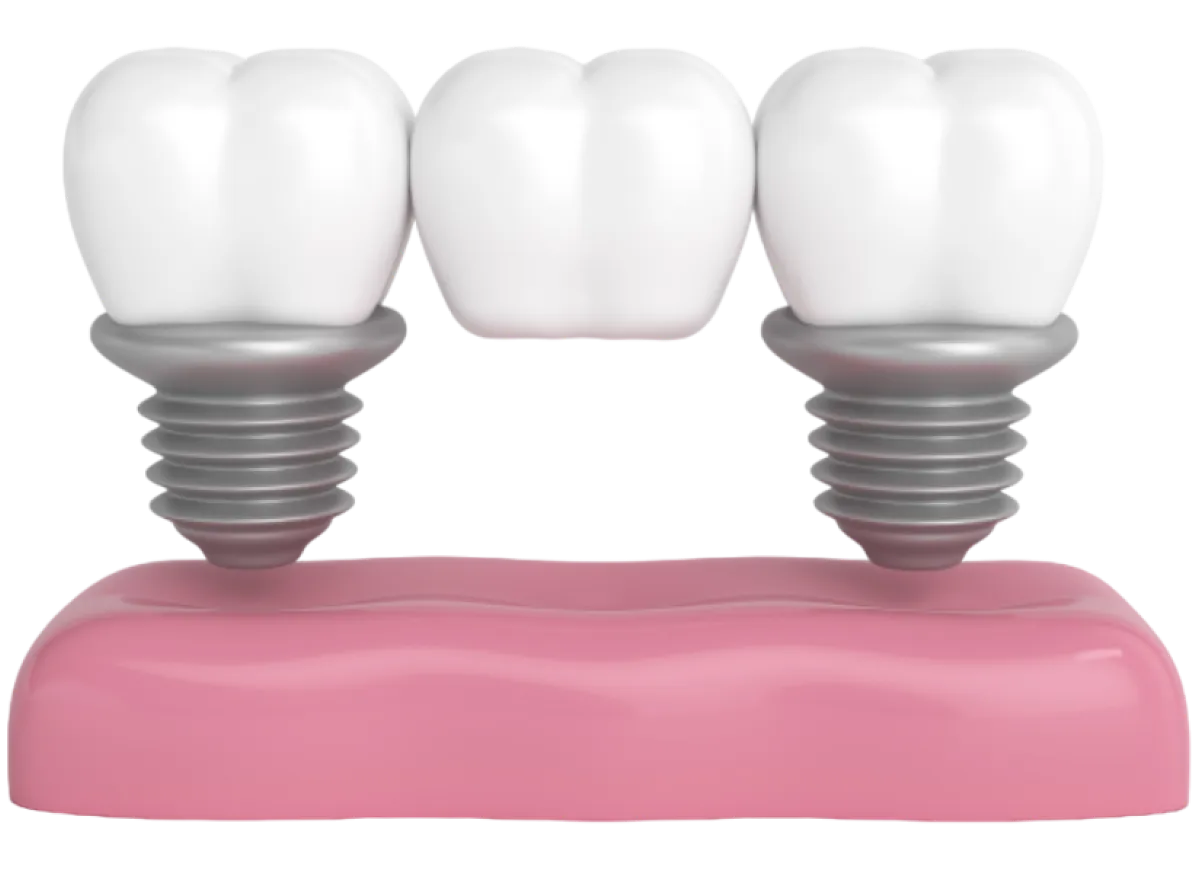 implante-dental-sobre-dentadura-3d-Photoroom-2 1